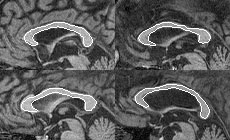 Automated segmentation of four corpora callosa.