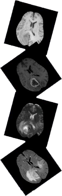 Brain tumor images